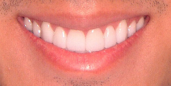 Case 4 — Cosmetic Reconstruction — after